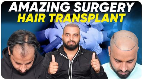 hair transplant in shimla